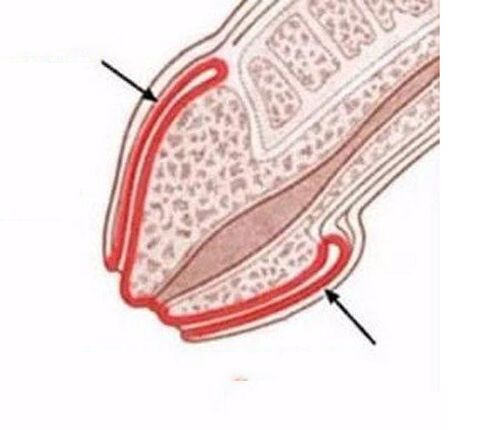 Inflammation of the penis