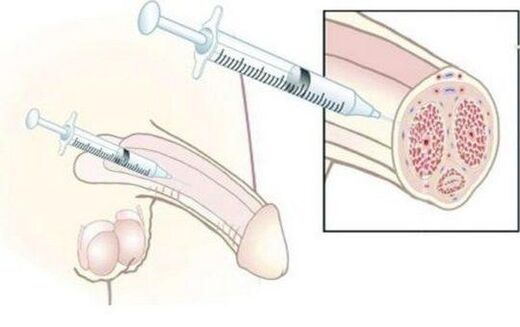Injoment of hyaluronic acid injections