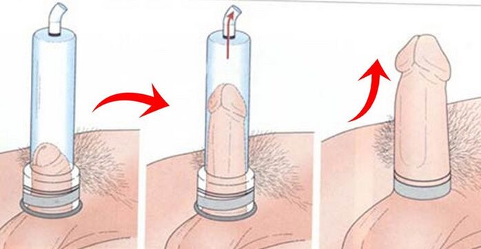 Using a pump for penis enlargement