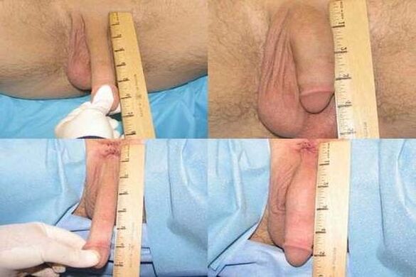 Penis measurement after enlargement surgery