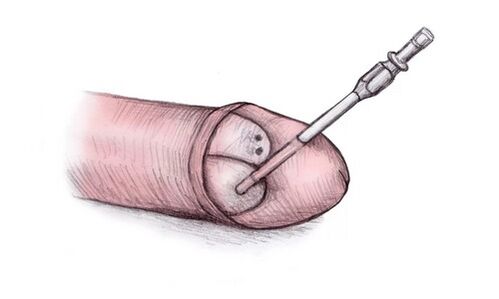 The glans can be enlarged by injecting hyaluronic gel
