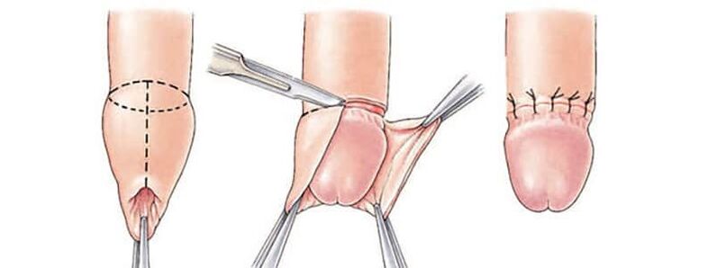 Effect of circumcision on penis size