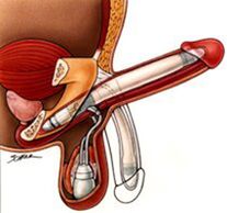 Penis enlargement implants for men
