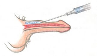Volumising hyaluronic acid injection into the penis